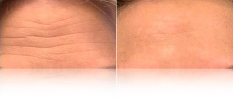 anti-wrinkle-botox-before-after-2-768x338