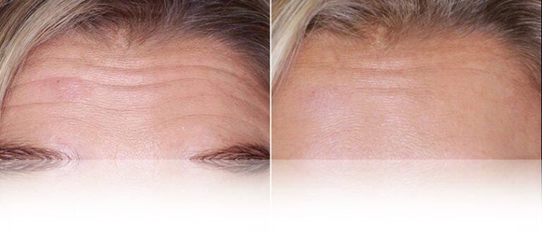 anti-wrinkle-botox-before-after-3-768x338
