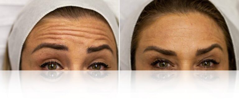 anti-wrinkle-botox-before-after-768x338