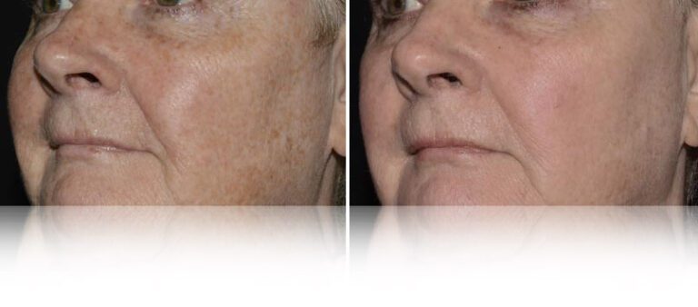 baby-face-laser-before-after-2-768x338
