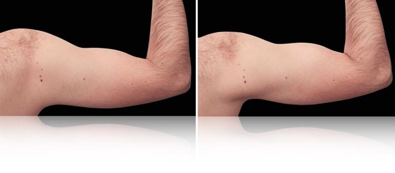 before-after-emsculpt-neo-biceps-arms-768x338