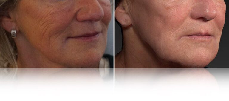 co2-laser-before-after-2-768x338