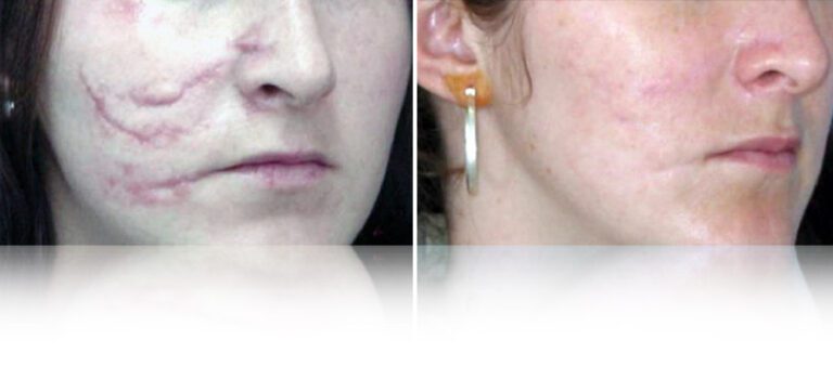 co2-laser-before-after-3-768x338