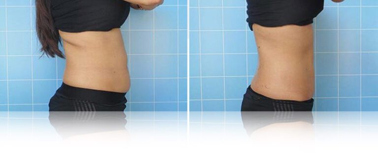 cooltech-fat-freezing-before-after-2-768x338