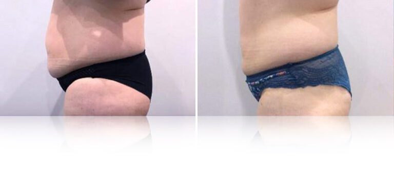 cooltech-fat-freezing-before-after-3-768x338