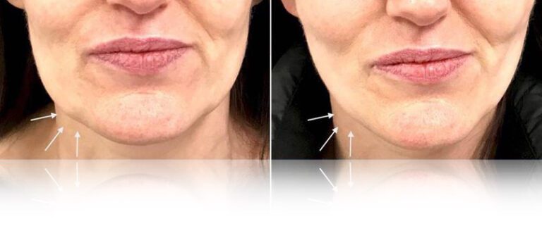 derma-fillers-before-after-768x338