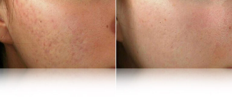 dermapen-microneedling-before-after-2.jpg