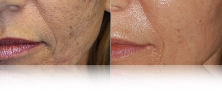 dermapen-microneedling-before-after.jpg