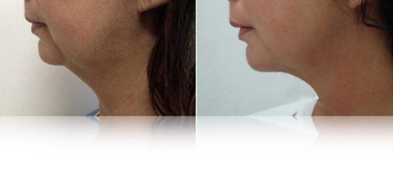endolift-before-after-2-768x338