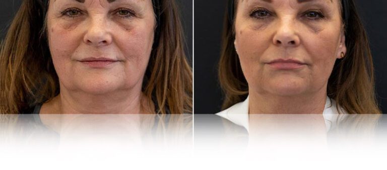 endolift-before-after-768x338