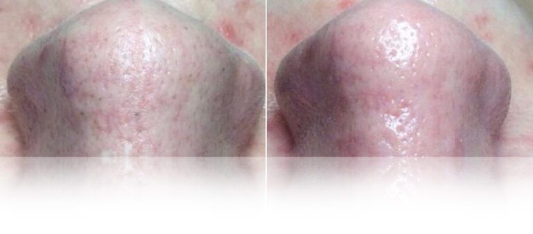 hydrafacial-treatment-before-after-2-768x338