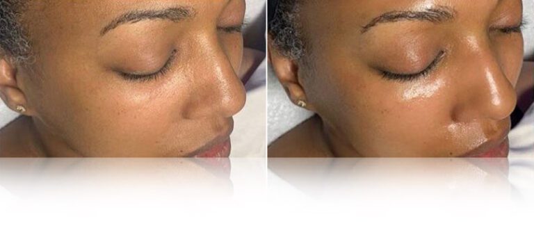 hydrafacial-treatment-before-after-768x338