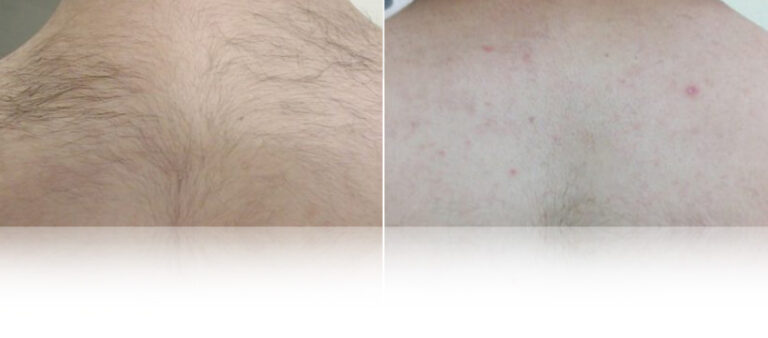 laser-hair-removal-before-after-2.jpg