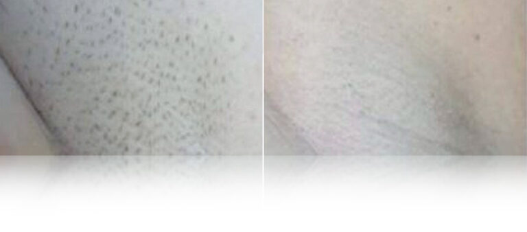 laser-hair-removal-before-after-3.jpg