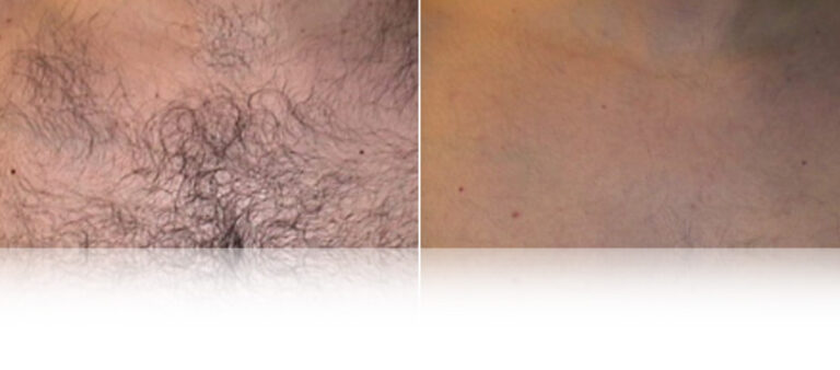 laser-hair-removal-before-after.jpg