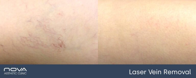 laser-vein-removal-before-after-768x305