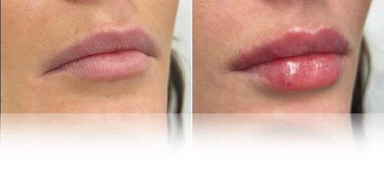 lip-filler-before-after-nova-2-768x338