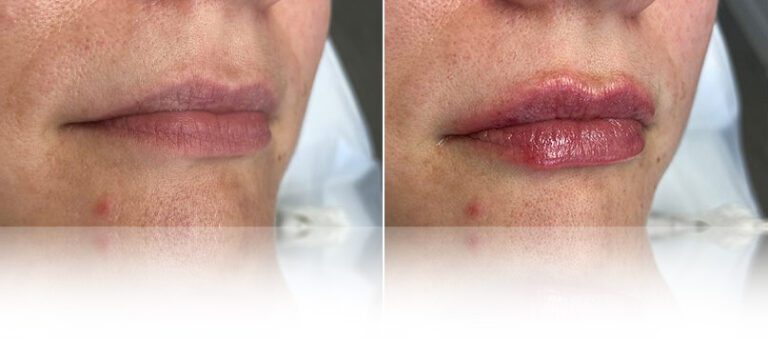 lip-filler-before-after-nova-3-768x338