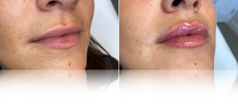 lip-filler-before-after-nova-768x338