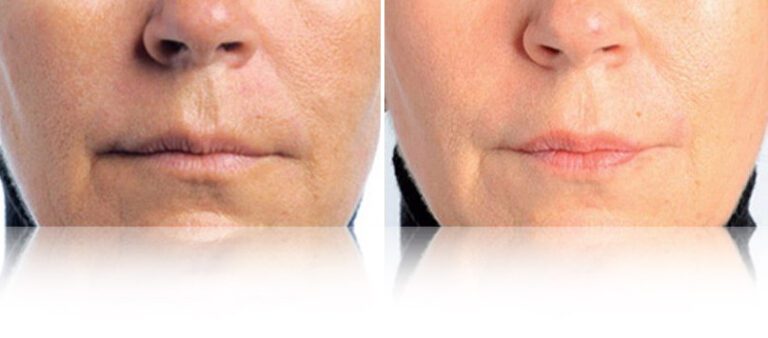 lpg-endermolift-before-after-2-768x338