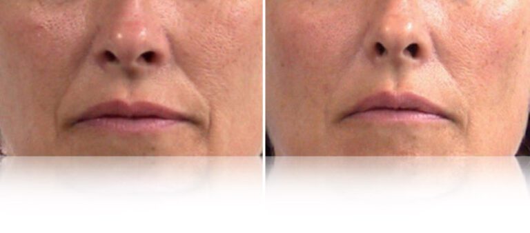lpg-endermolift-before-after-768x338