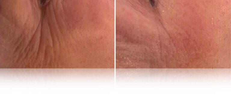mesotherapy-face-neck-before-after-2-768x338 (1)