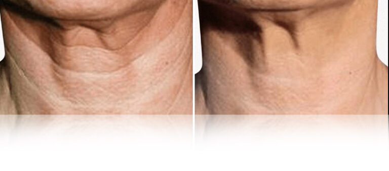 mesotherapy-face-neck-before-after-3-768x338 (1)