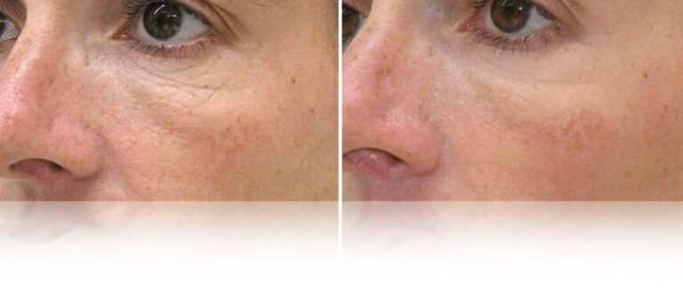 mesotherapy-face-neck-before-after-768x338 (1)