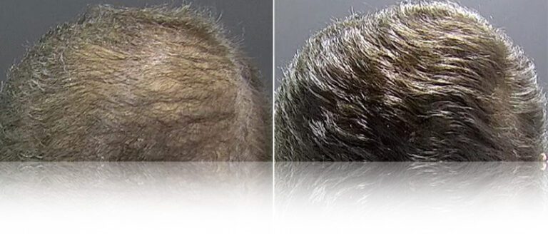 mesotherapy-hair-before-after-2-768x338 (1)