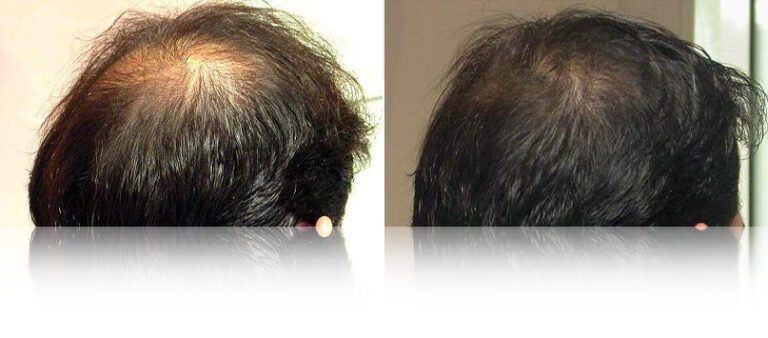 mesotherapy-hair-before-after-768x338 (1)