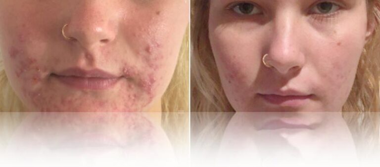 microneedling-acne-before-after-768x338