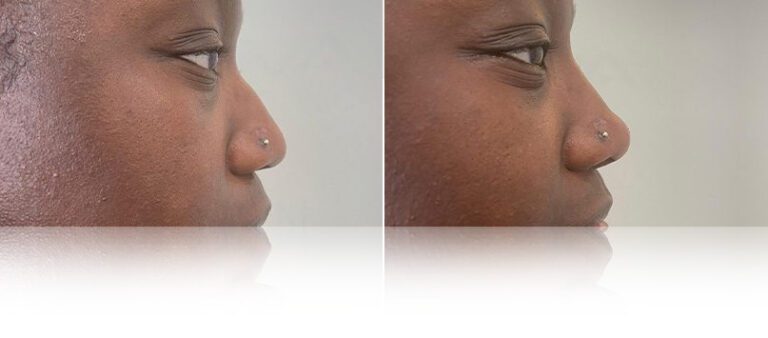 nose-filler-before-after-nova-768x338