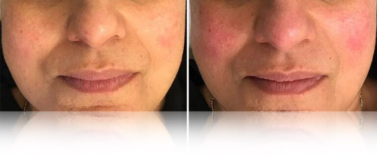 oxygen-facial-before-after-2-768x338