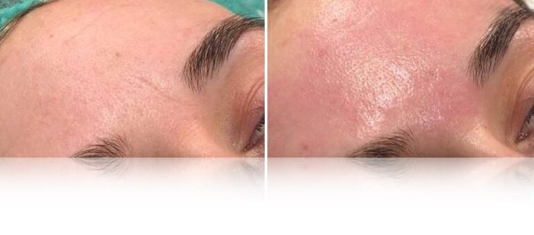 oxygen-facial-before-after-3-768x338