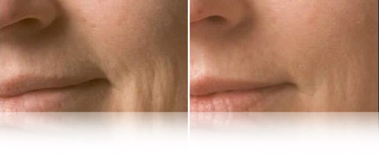 oxygen-facial-before-after-768x338