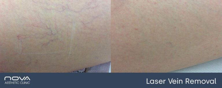 thread-veins-leg-before-after-768x305