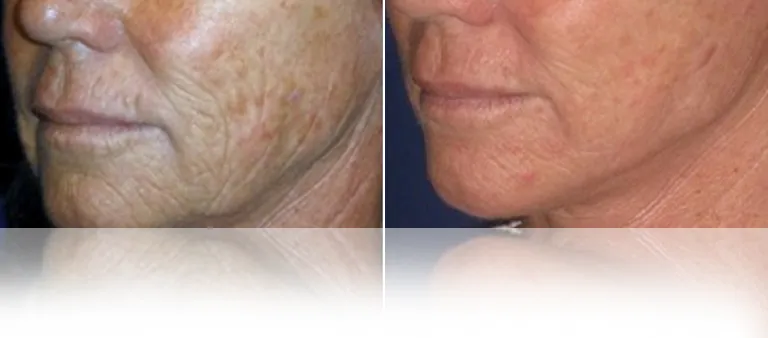 eCO2-Combined with Facelift Wrinkles and Pigment