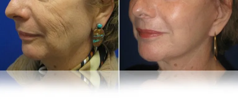 eCO2-Combined with Facelift Wrinkles and Texture (2)