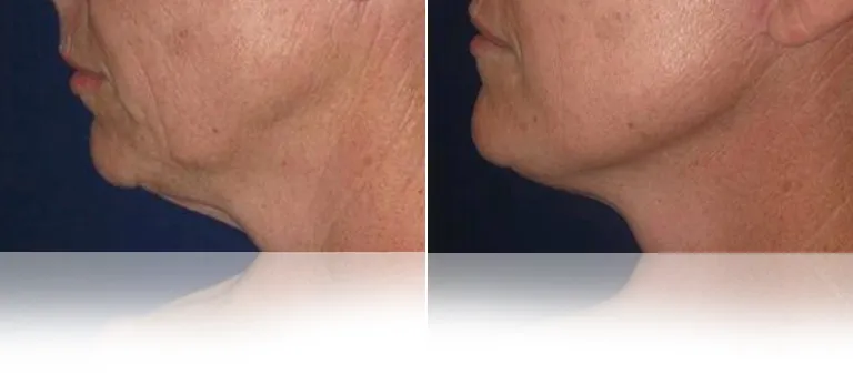eCO2-Combined with Facelift Wrinkles and Texture