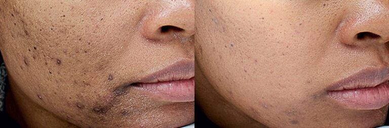 skin-peel-chemical-before-after