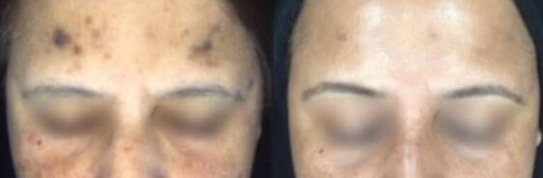 skin-peel-pigmentation-before-after (1)
