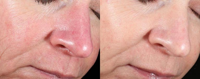 derma-v-lutronic-before-after-2