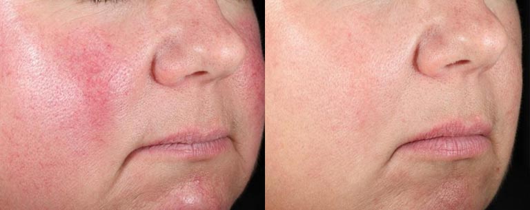 derma-v-lutronic-before-after