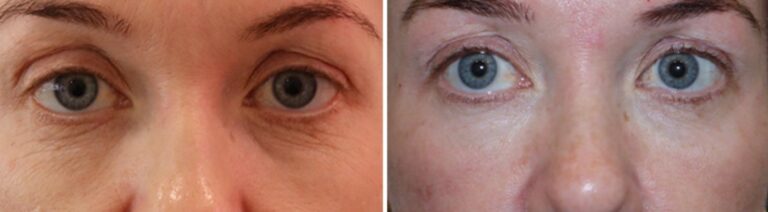 polynucleotides-before-after-2-offer