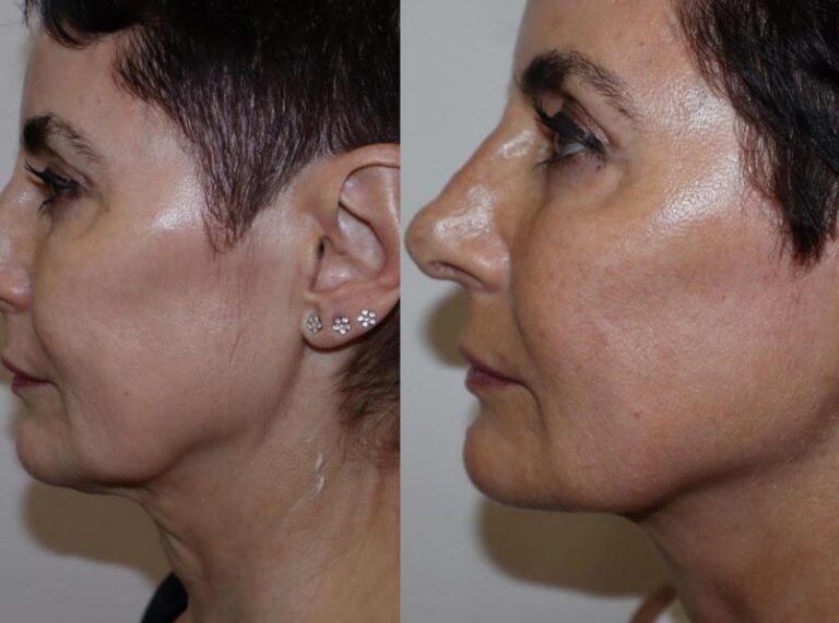 polynucleotides-before-after-5-offer