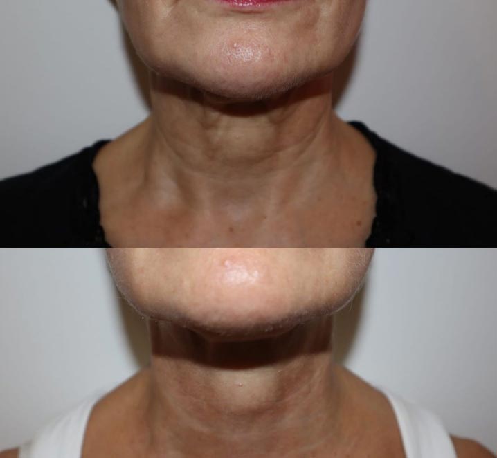polynucleotides-before-after-6-offer
