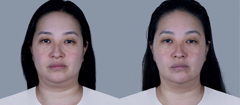 sculptra-b-a-1