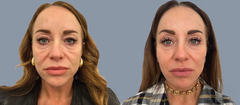 sculptra-b-a-3