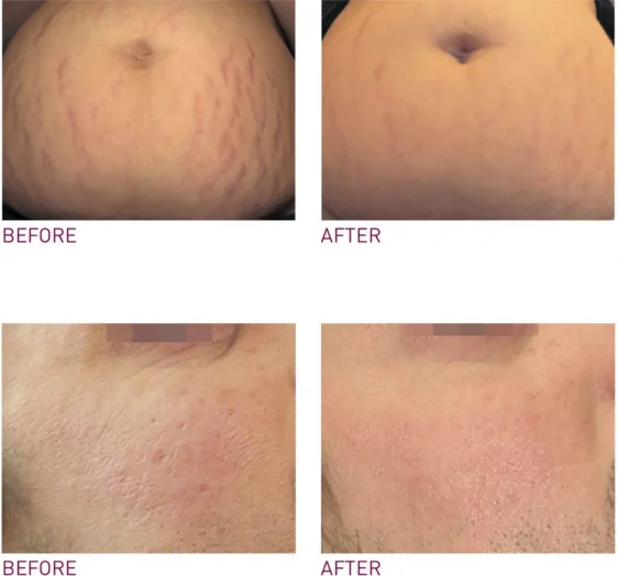 PRX-before-after